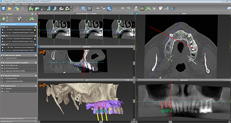 implantologia computer assistita