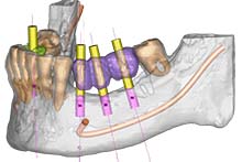 implantologia guidata computerizzata