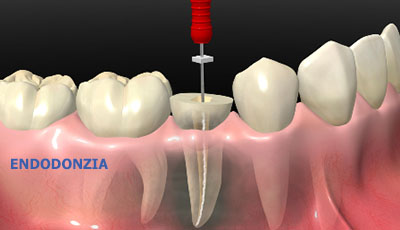 endodonzia