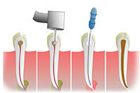 endodonzia