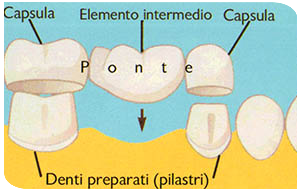 protesi ponti
